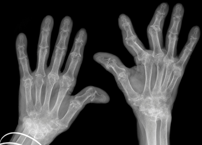 Rheumatoid arthritis causes damage and deformity of the joints.