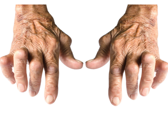 Rheumatoid arthritis causes hand deformity