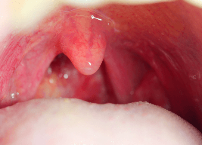 Herpes sore deals throat