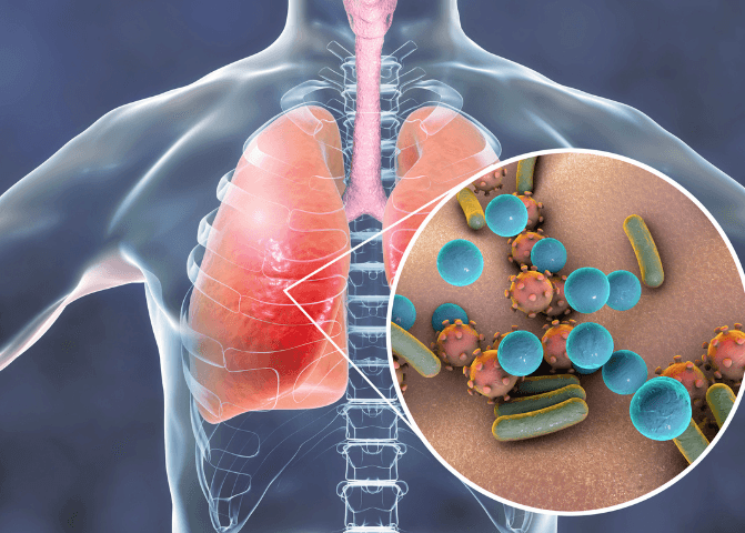 Chest Infection And Cough How To Treat Guide Medmate