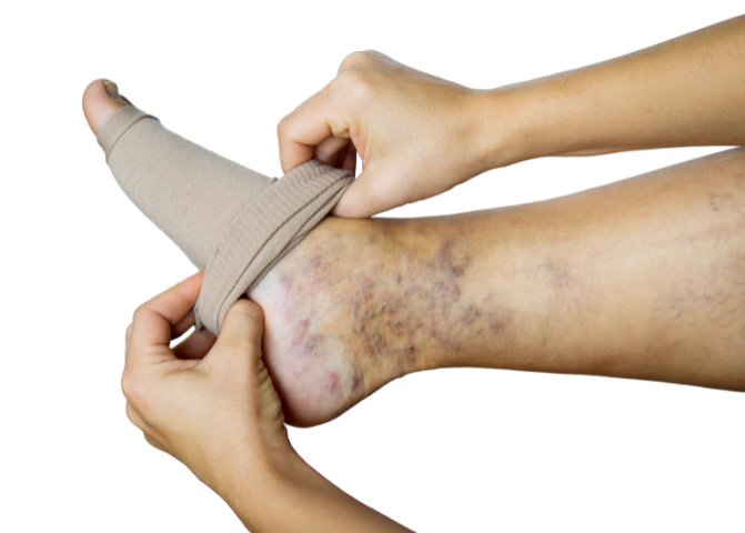 The Benefits of Compression Stockings for Diabetic Feet During